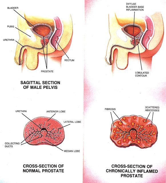 Prostate Rub